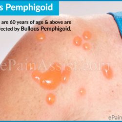 Bullous pemphigoid and coconut oil