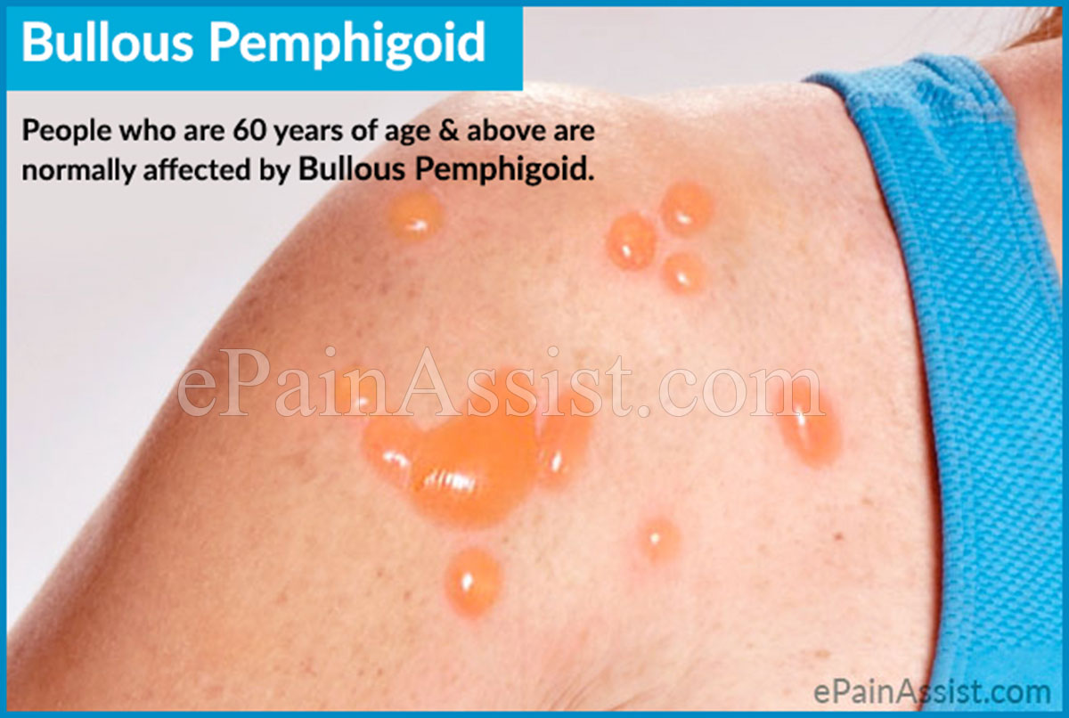 Bullous pemphigoid and coconut oil